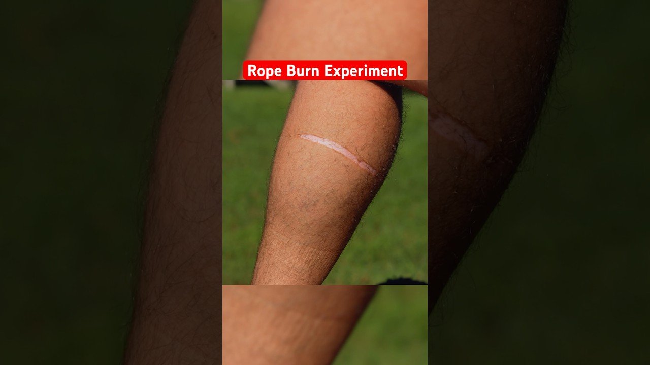 Insanely Painful ROPE BURN Experiment… #funny #science #comedy post thumbnail image